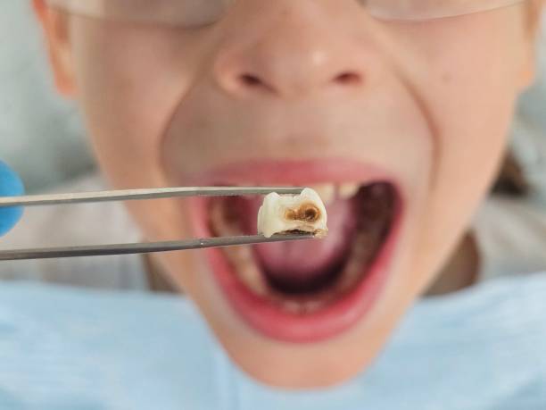 Best Emergency Dentist for Lost Fillings or Crowns in Red Lion, PA